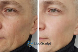 Fight Aging Symptoms Buckinghamshire With HIFU and Morpheus8 Today!