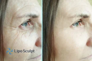Do you want to Fight Aging Symptoms Buckinghamshire? Contact Lipo Sculpt today!