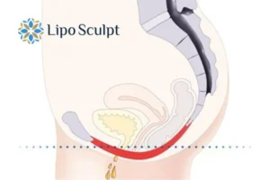Pelvic Floor Chair Therapy Buckinghamshire to treat incontinence.