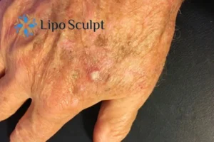 Improve your wellbeing and health with Actinic Keratoses Buckinghamshire removal.treatment